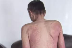 Больной псориазом заразился гепатитом и отказался лечиться в Акмолинской области